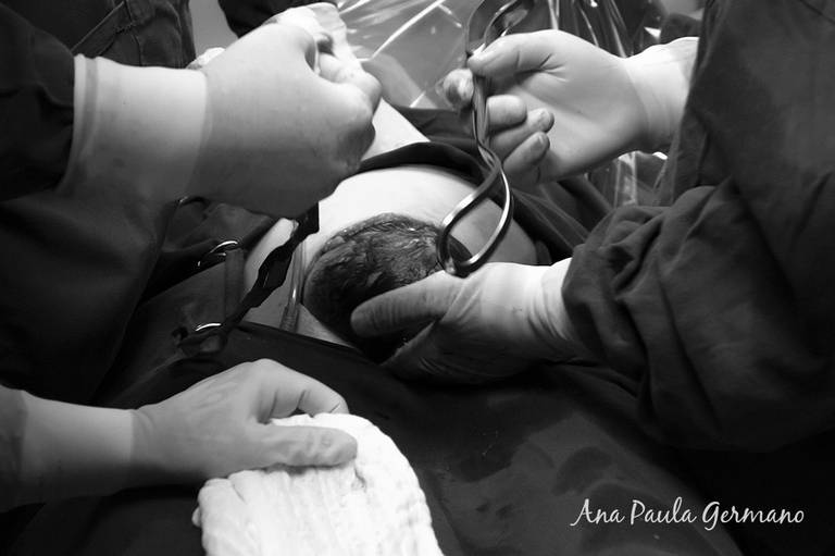 FOTOGRAFO de PARTO/SP: Parto Cesárea – Maternidade SANTA JOANA/SP