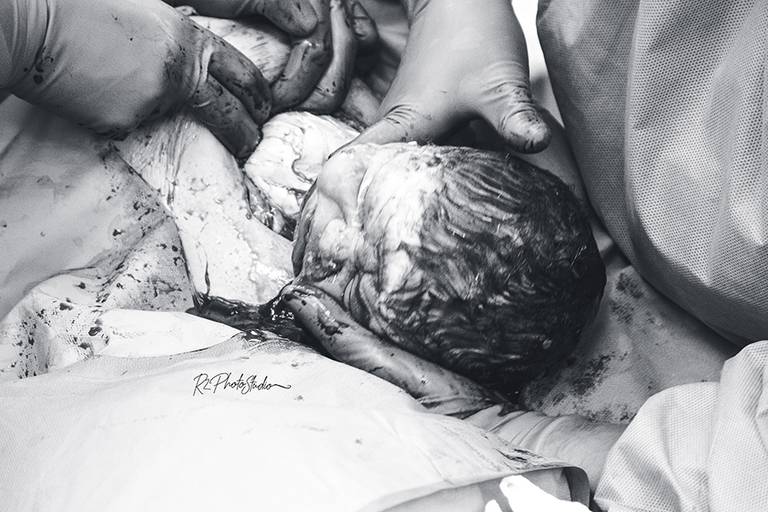 Foto de Bebe com a cabeça para fora da barriga durante o parto