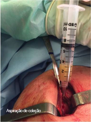 Aspiração de coleção